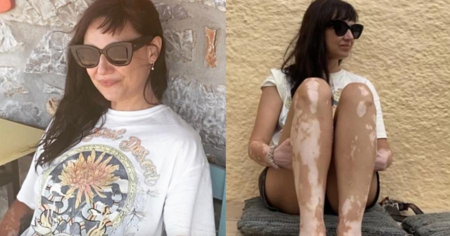 Μαθήματα αυτοαγάπης από την Αθηναΐς Νέγκα: «Πήρα τη λεύκη μου για ποτό στην Άνω Σύρο» – Ένα δυνατό μήνυμα για τα αυτοάνοσα