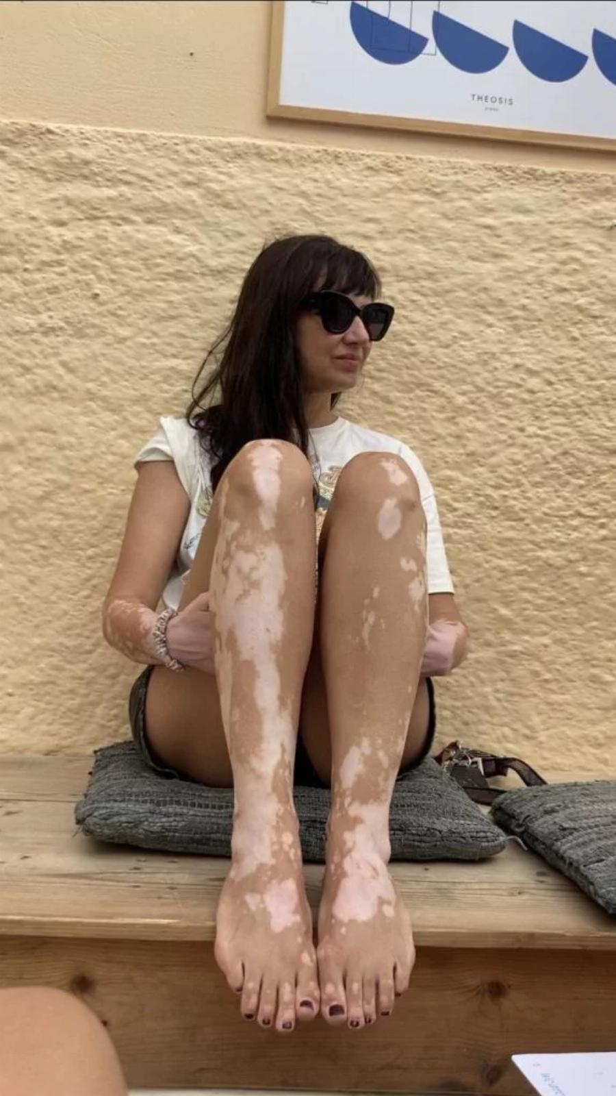 Μαθήματα αυτοαγάπης από την Αθηναΐς Νέγκα: «Πήρα τη λεύκη μου για ποτό στην Άνω Σύρο» – Ένα δυνατό μήνυμα για τα αυτοάνοσα