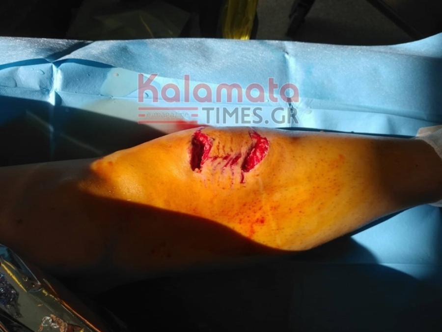 Την κατασπάραξαν τα σκυλιά: Η 34χρονη μητέρα που δέχτηκε άγρια επίθεση άγρια και τα σοβαρά τραύματα