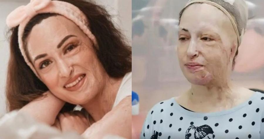 Παίρνει τη ζωή της πίσω: Η Ιωάννα Παλιοσπύρου στο κέντρο αποκατάστασης, οι φωτογραφίες από την στιγμή που της καθαρίζουν τις ουλές