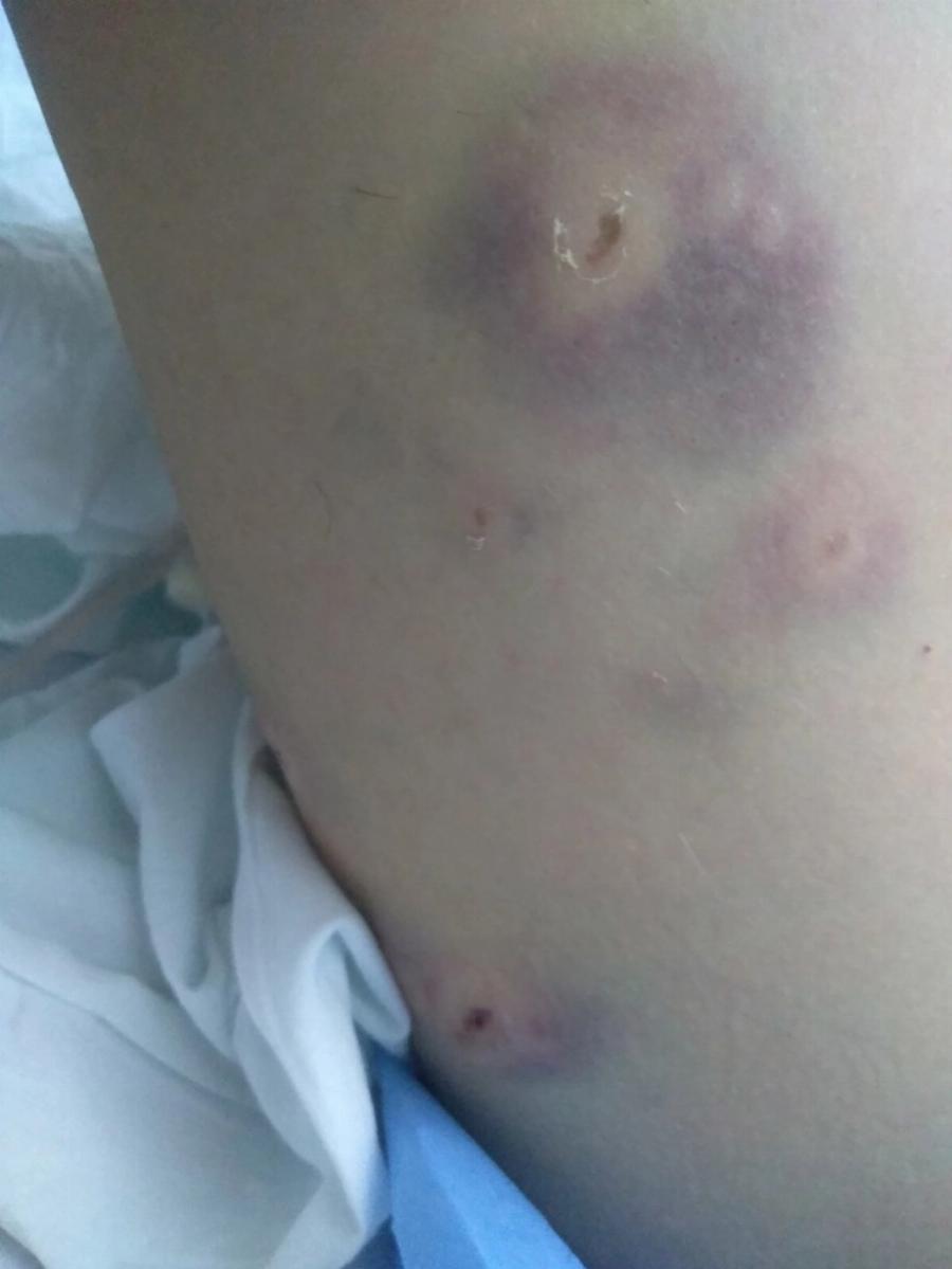 Την κατασπάραξαν τα σκυλιά: Η 34χρονη μητέρα που δέχτηκε άγρια επίθεση άγρια και τα σοβαρά τραύματα