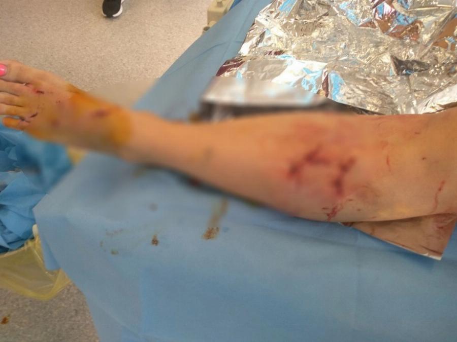 Την κατασπάραξαν τα σκυλιά: Η 34χρονη μητέρα που δέχτηκε άγρια επίθεση άγρια και τα σοβαρά τραύματα