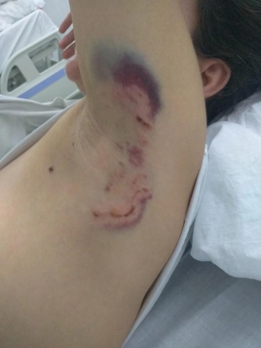 Την κατασπάραξαν τα σκυλιά: Η 34χρονη μητέρα που δέχτηκε άγρια επίθεση άγρια και τα σοβαρά τραύματα