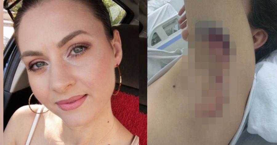 Την κατασπάραξαν τα σκυλιά: Η 34χρονη μητέρα που δέχτηκε άγρια επίθεση άγρια και τα σοβαρά τραύματα