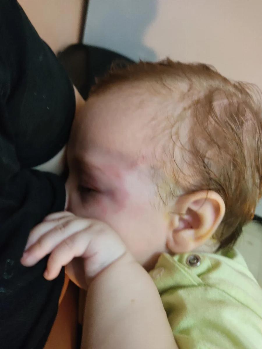 Σοκαριστική επίθεση από σκύλο σε παιδί στην Κρήτη: «Δάγκωνε με μανία το παιδί μου» – Το βρέφος έχει σκίσιμο τριών εκατοστών στο μάτι