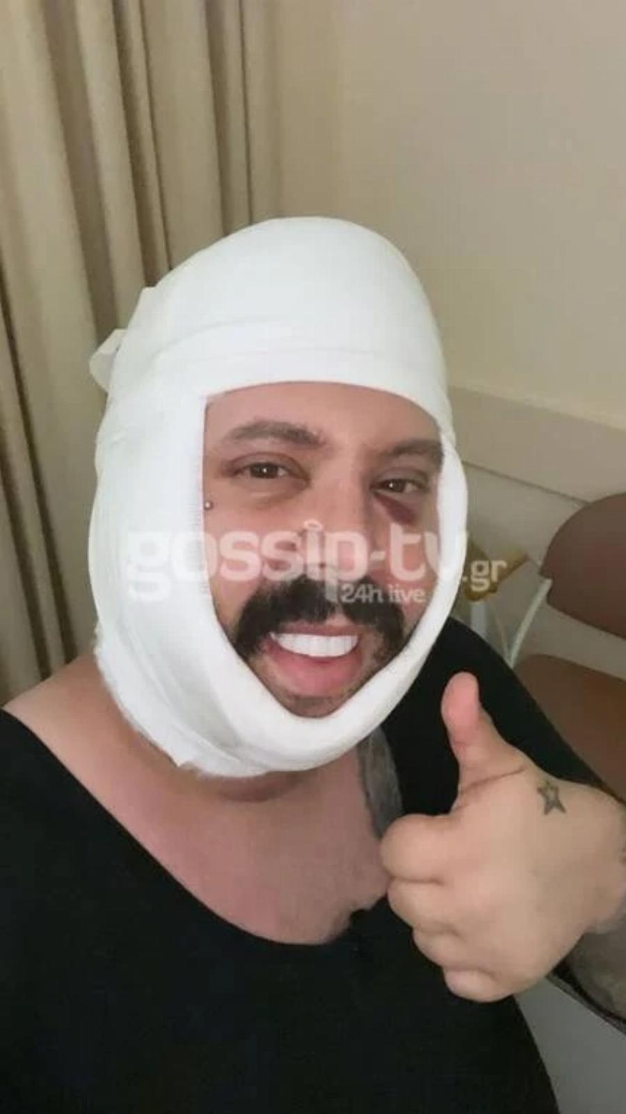 Έβαλε χείλια, δόντια και άλλαξε παντελώς: Αγνώριστος ο Νικόλας του Big Brother 2 χρόνια μετά το τέλος του παιχνιδιού