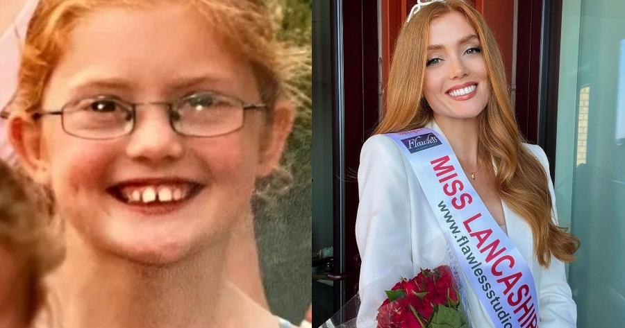 Την κορόιδευαν αλλά σήμερα την θαυμάζουν : Η Μις Αγγλία 2022 όταν ήταν μικρή έπεσε θύμα bullying