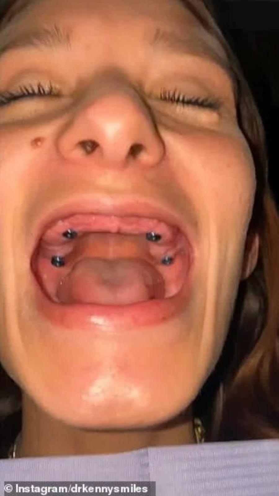 Απέκτησε και πάλι το χαμόγελό της: Έχασε όλα τα δόντια της από τις καταχρήσεις και ένας οδοντίατρος την μεταμόρφωσε