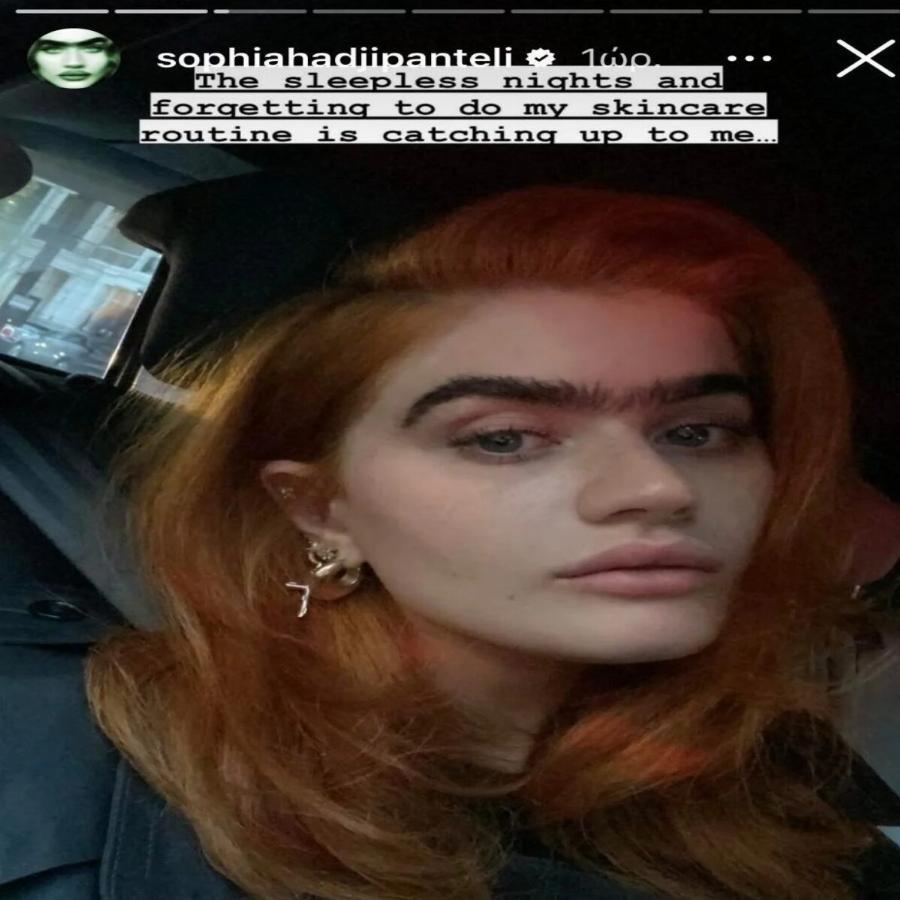 «Πείτε με “ψεύτικη” όσο θέλετε»: Η Σοφία Χατζηπαντελή ανέβασε φωτογραφίες μετά το μπότοξ