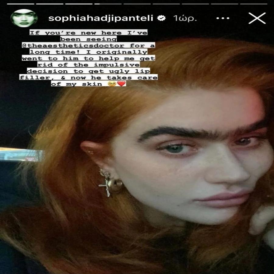 «Πείτε με “ψεύτικη” όσο θέλετε»: Η Σοφία Χατζηπαντελή ανέβασε φωτογραφίες μετά το μπότοξ