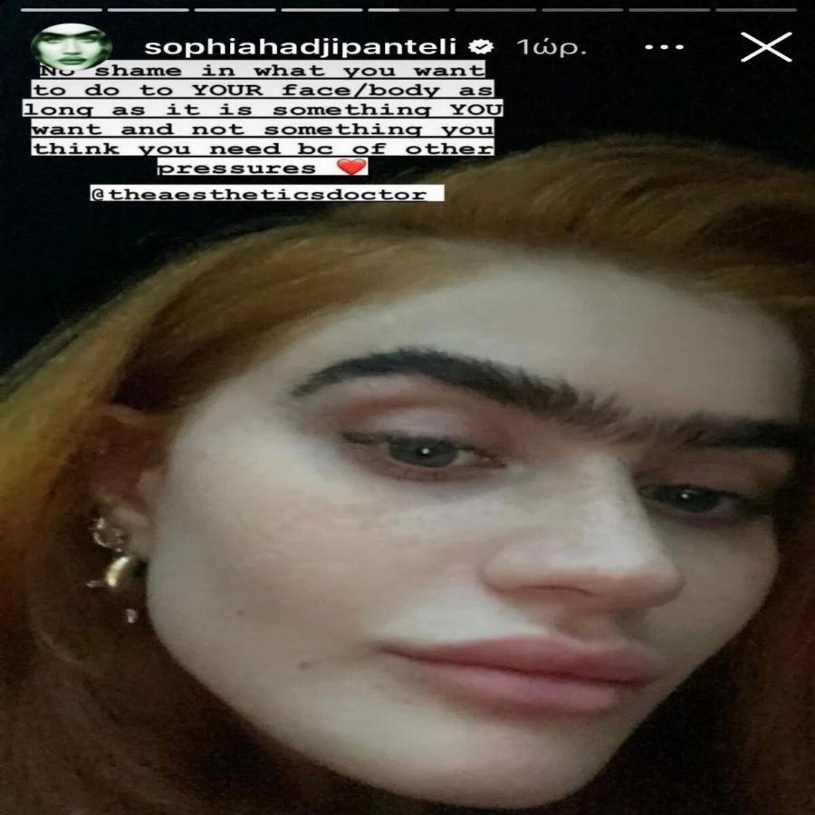 «Πείτε με “ψεύτικη” όσο θέλετε»: Η Σοφία Χατζηπαντελή ανέβασε φωτογραφίες μετά το μπότοξ