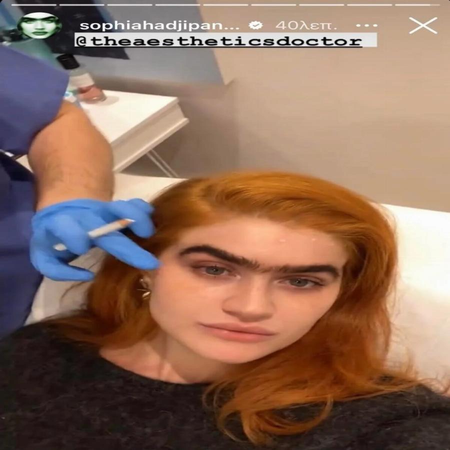 «Πείτε με “ψεύτικη” όσο θέλετε»: Η Σοφία Χατζηπαντελή ανέβασε φωτογραφίες μετά το μπότοξ