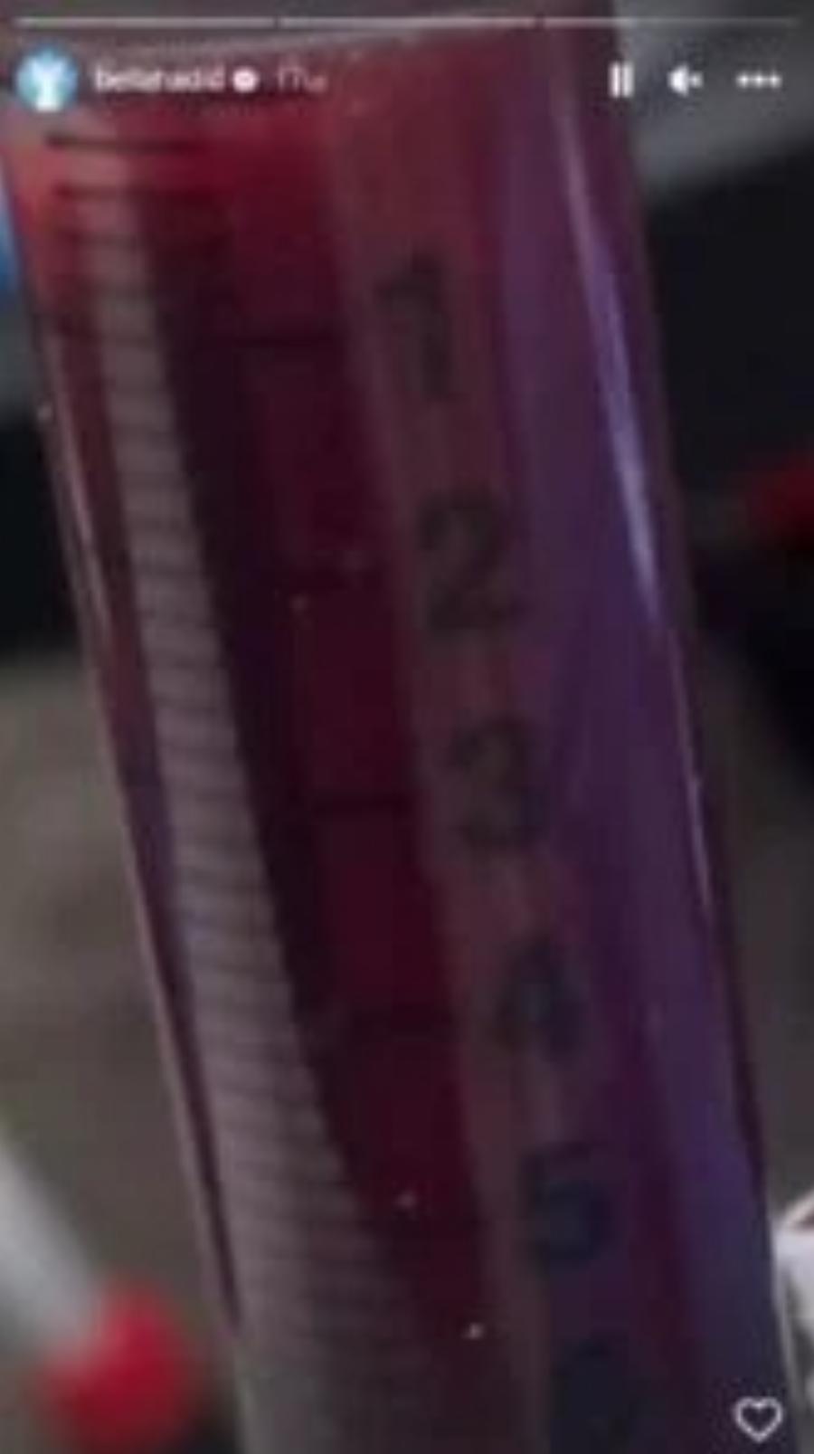 Μυστήριο με την υγεία της Μπέλα Χαντίντ: Τα μελανιασμένα πόδια και οι επίδεσμοι στην πλάτη που τρόμαξαν τους ακόλουθους