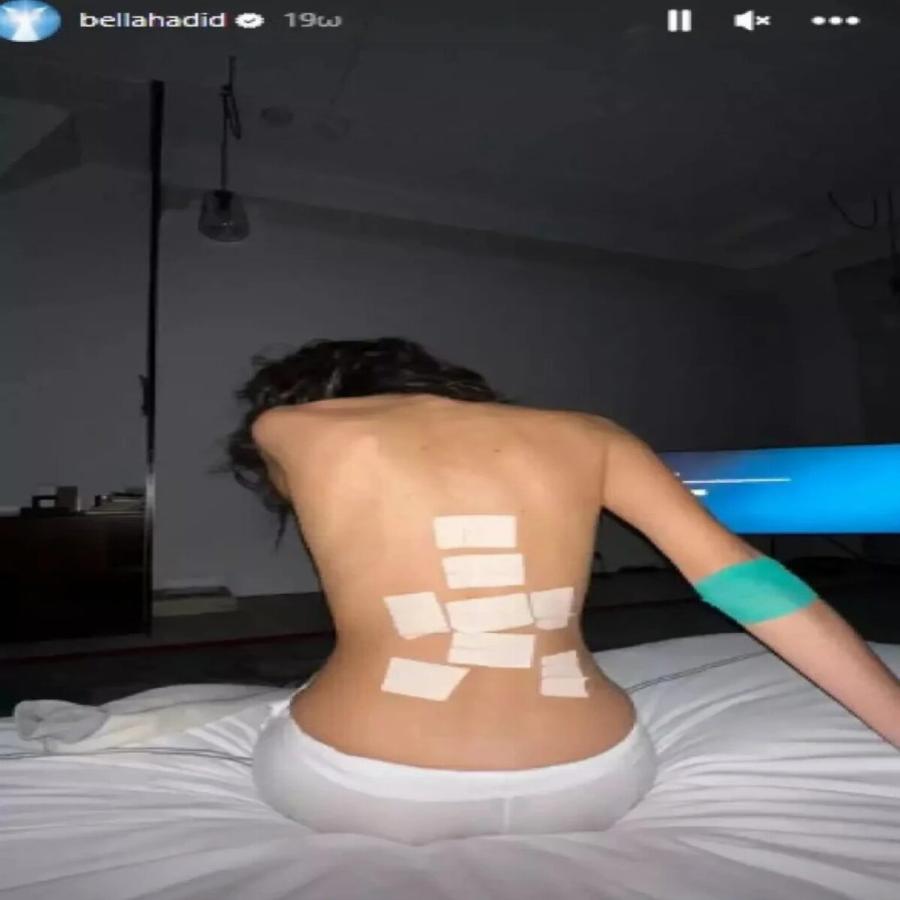 Μυστήριο με την υγεία της Μπέλα Χαντίντ: Τα μελανιασμένα πόδια και οι επίδεσμοι στην πλάτη που τρόμαξαν τους ακόλουθους