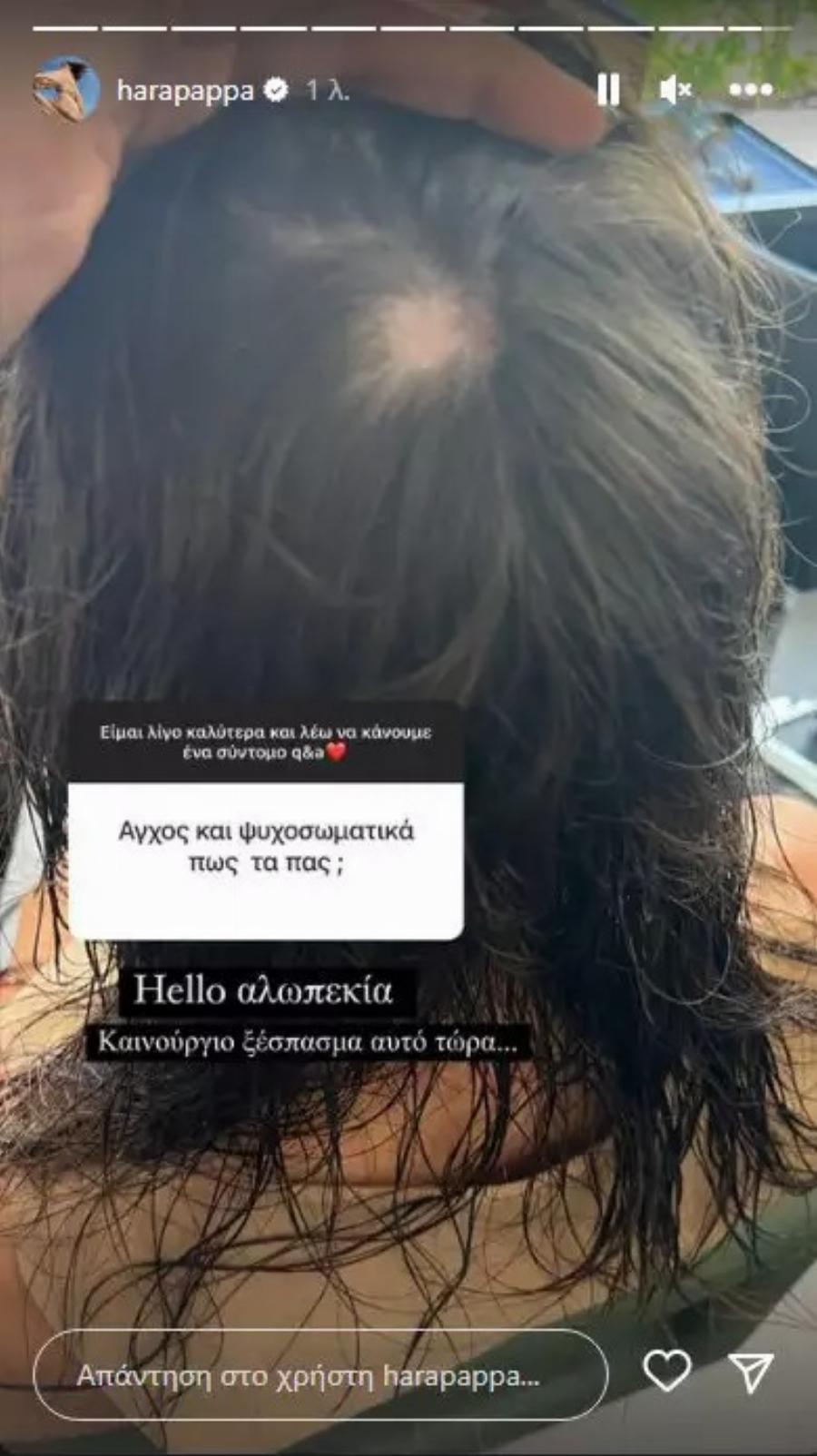 Το αυτάνοσο νόσημα από το οποίο πάσχει η Χαρά Παππά: Η φωτογραφία που δημοσίευσε και η αποκάλυψη για την αλωπεκία