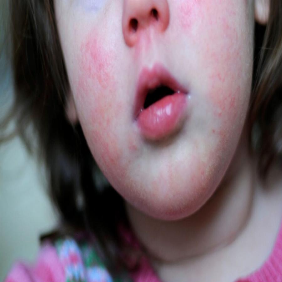 «Προσοχή στα συμπτώματα»: Η συγκλονιστική μαρτυρία ενός πατέρα 4χρονης με στρεπτόκοκκο