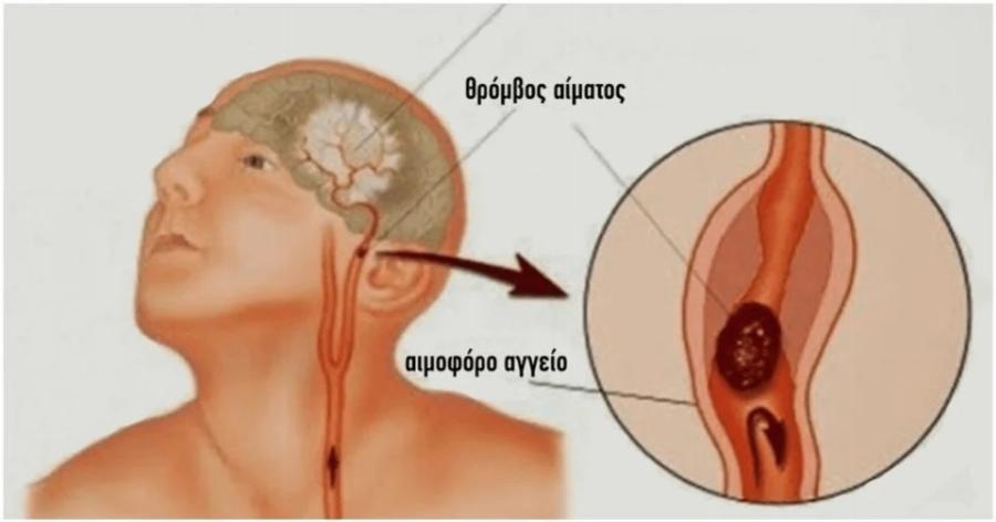 Σώζει ζωές και αξίζει να το ξέρετε: Tι πρέπει να κάνουμε σε περίπτωση εγκεφαλικού επεισοδίου