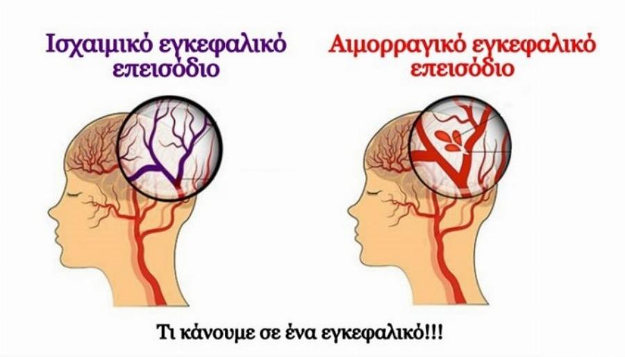 Σώζει ζωές και αξίζει να το ξέρετε: Tι πρέπει να κάνουμε σε περίπτωση εγκεφαλικού επεισοδίου