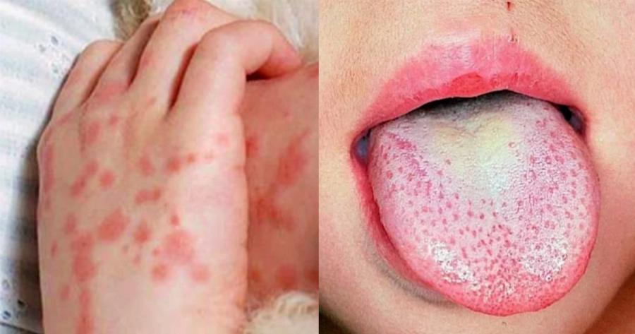 Συναγερμός για τεράστιο κύμα «οστρακιάς»: Τα ανησυχητικά συμπτώματα και ο τρόπος για να προστατευθείτε