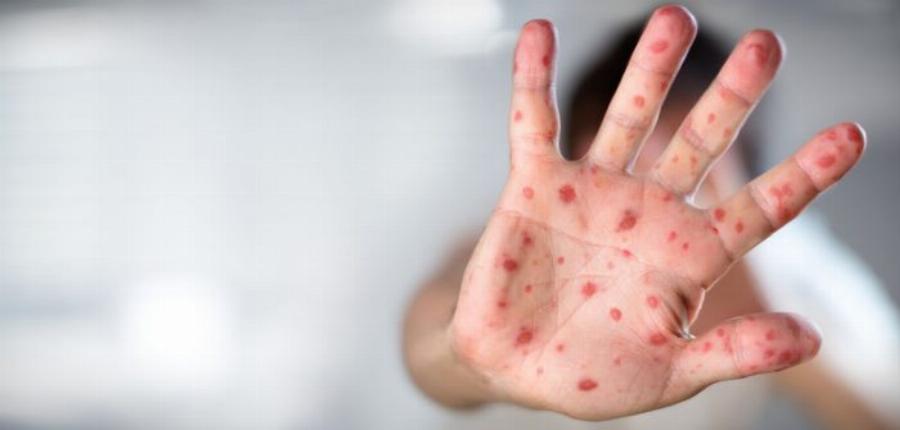 Συναγερμός για τεράστιο κύμα «οστρακιάς»: Τα ανησυχητικά συμπτώματα και ο τρόπος για να προστατευθείτε