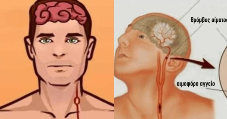 Σώζει ζωές: Τι πρέπει να κάνουμε σε περίπτωση εγκεφαλικού, παίρνει μόνο 1 λεπτό για να το διαβάσετε