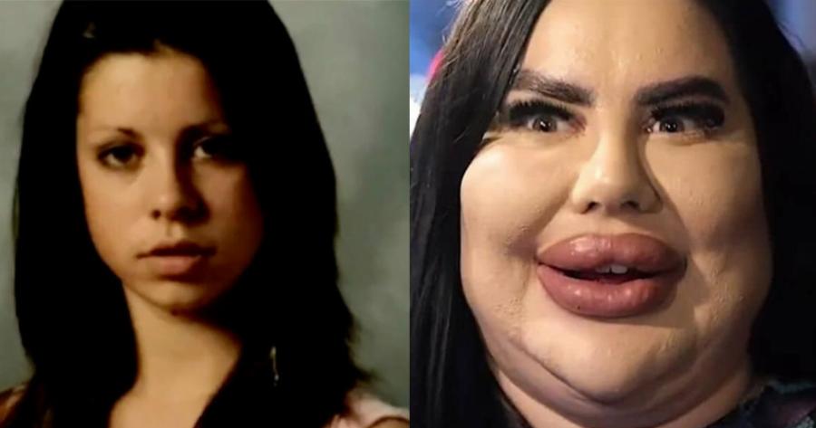 Η 27χρονη που πήγε στο άλλο άκρο: «Ξόδεψα 150.000 σε πλαστικές επεμβάσεις, αλλά δεν βρίσκω σύντροφο γιατί τρομάζω τους άντρες»