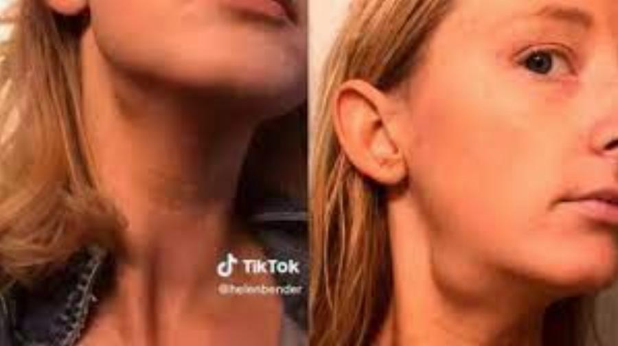 Ανακάλυψε κατά τύχη πως έχει όγκο στο λαιμό: Η 26χρονη Ελένη βρήκε ότι έχει καρκίνο μέσα από ένα βίντεο στο Tik Τok