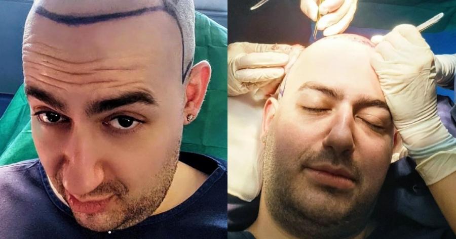 «Η ανδρογενής αλωπεκία μου χτύπησε την πόρτα»: Έμεινε φαλακρός ο Μαυρίκιος Μαυρικίου, η εικόνα μέσα από το χειρουργείο