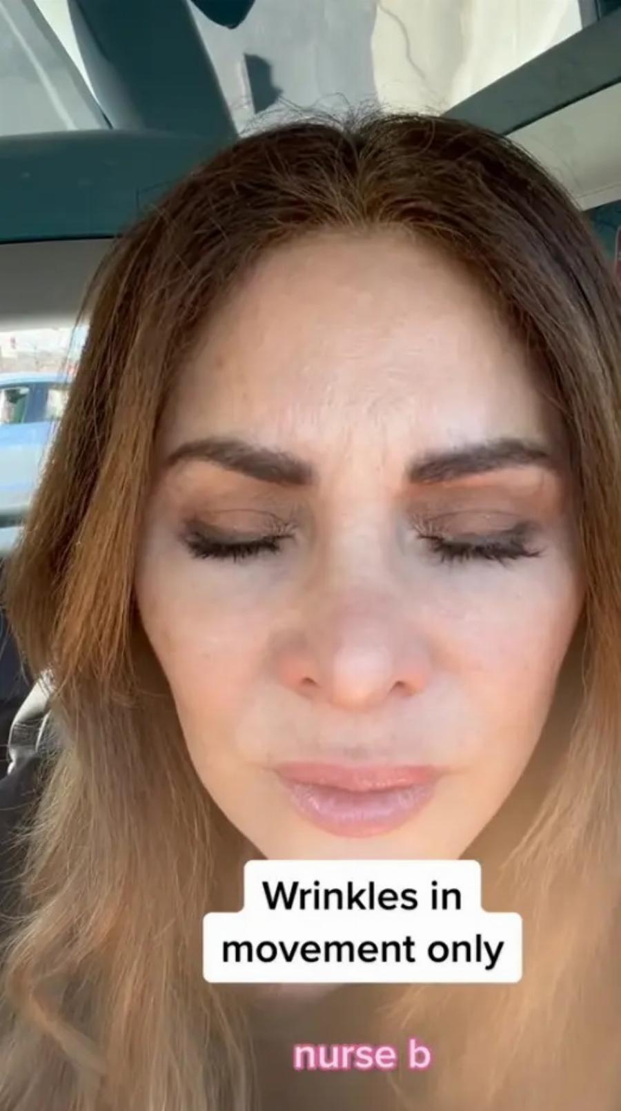 «Πάγωσαν» οι ακόλουθοι με το αποτέλεσμα: Νοσηλεύτρια έκανε μπότοξ για 20 χρόνια, το έκοψε «μαχαίρι» και δείχνει πώς είναι το πρόσωπό της