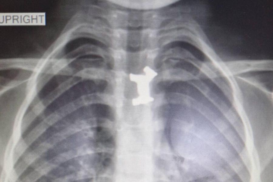 5χρονο αγόρι σώθηκε από θαύμα: Κέρδισε τη μάχη για τη ζωή, αφού κατάπιε μεταλλικό παιχνίδι