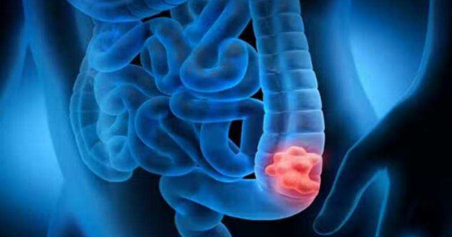 Self test για τον καρκίνο του παχέος εντέρου στα φαρμακεία – Δωρεάν με ένα SMS