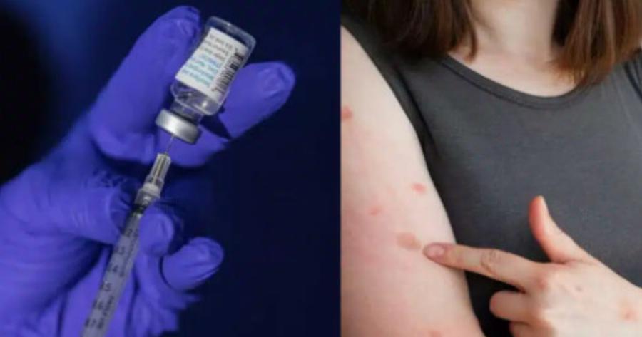 Ανοίγουν 5 εμβολιαστικά κέντρα σε όλη την Ελλάδα για την ευλογιά των πιθήκων