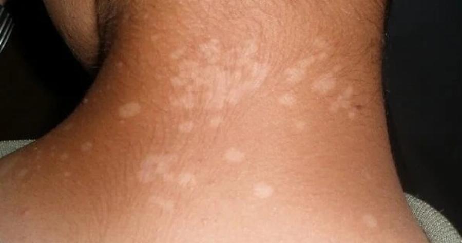 Γιατί εμφανίζονται μικρές λευκές κηλίδες στο δέρμα σας