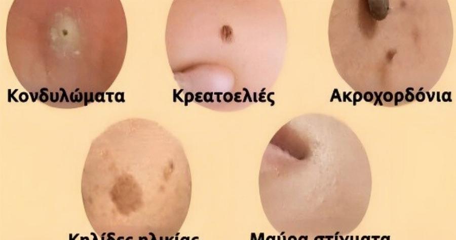 Πώς να αφαιpέσετε φυσικά κηλίδες, κρεατοελιές, μυρμηγκιές και μαύρα στίγματα