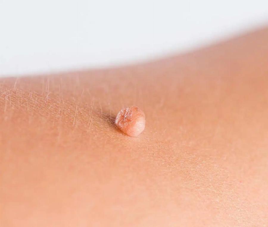 Πώς να αφαιpέσετε φυσικά κηλίδες, κρεατοελιές, μυρμηγκιές και μαύρα στίγματα