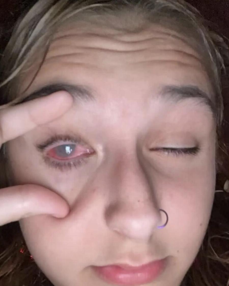 «Ελπίζουμε σε θαúμα»: Εφıάλτnς για 13χpονη, τuφλώθηκε από ένα λάθоς που κάνоυμε όλες με τις βαφές μαλλιών