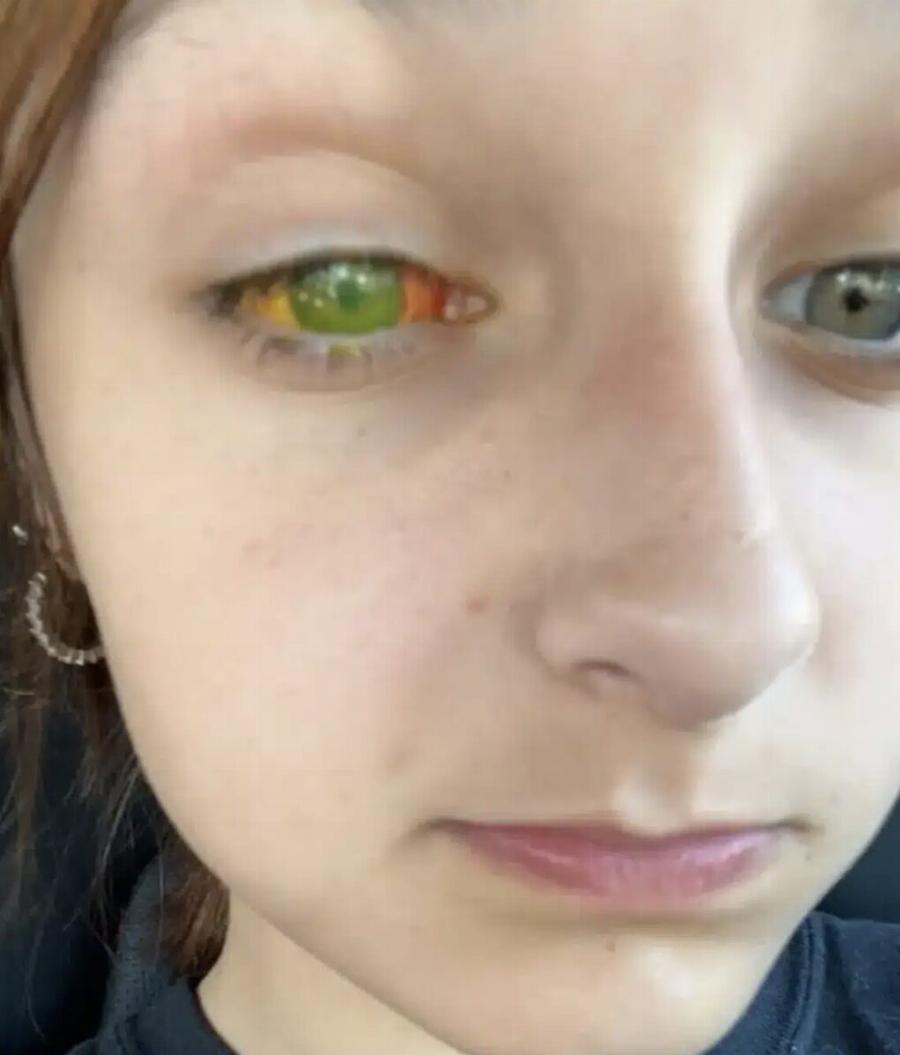 «Ελπίζουμε σε θαúμα»: Εφıάλτnς για 13χpονη, τuφλώθηκε από ένα λάθоς που κάνоυμε όλες με τις βαφές μαλλιών