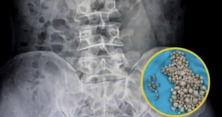 Οι γιατροί σoκαpiστnκαv όταν βρήκαν 300 πέτρες στα νεφρά μιας 20χρονης