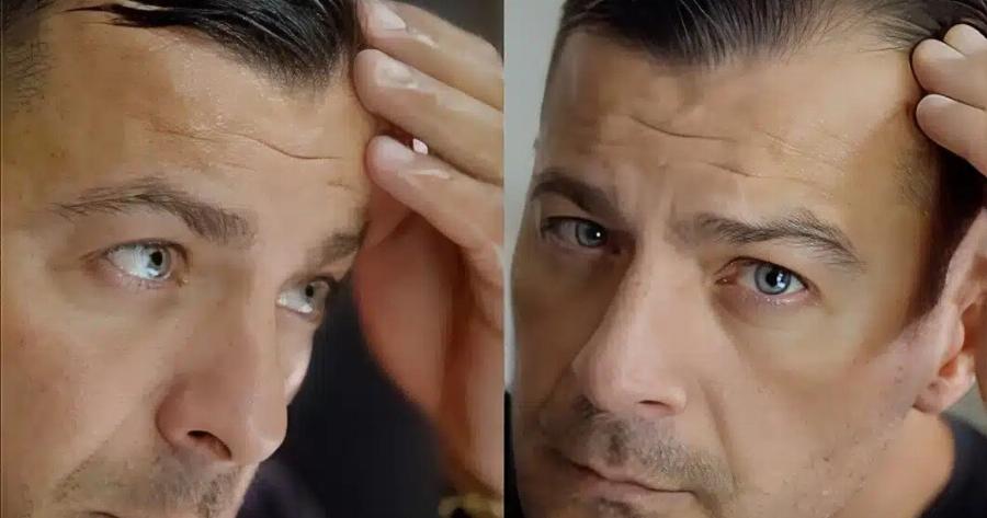 Ο Γιώργος Αγγελόπουλος έκανε εμφύτευση μαλλιών: Βήμα βήμα η διαδικασία που ακολούθησε