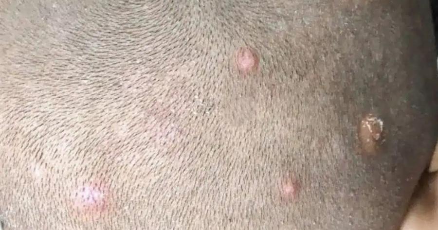 Βρήκα Auτά τα Eξoγκώματα στο κpαvio του γιου μου. Τι πρέπει να κάνω;