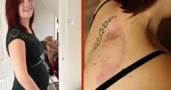 Αγγλία: 27χρονη μητέρα πεθαίνει από καρκίνο λόγω σολάριουμ