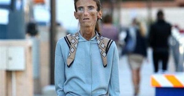 «Μάχη κατά της ανορεξίας!» Ο τρόπος που έμοιαζε το κορίτσι πριν από την ανορεξία άφησε τους πάντες άφωνους