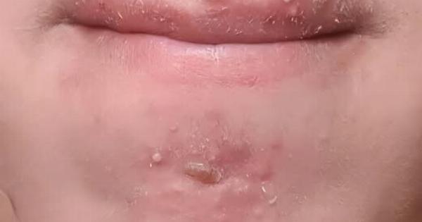 Έβγαινα με μια γυναίκα που γνώρισα στο σουπερμάρκετ και αφού τελικά πήγα μαζί της ξύπνησα με αυτά στο πρόσωπό μου. Τι είναι αυτό;