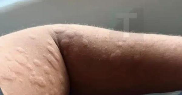 Τι είναι, πώς εμφανίζεται και πότε χρειάζεται ιατρική επίβλεψη