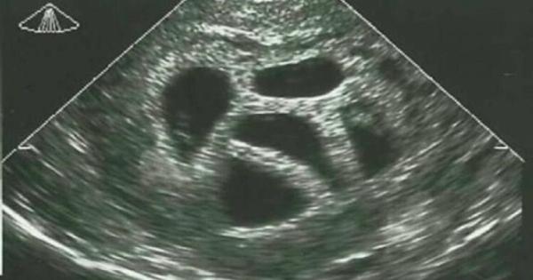 Μια έγκυος γυναίκα αγνόησε τις συμβουλές του γιατρού να κάνει έκτρωση… 20 χρόνια αργότερα δημοσιεύει αυτό!