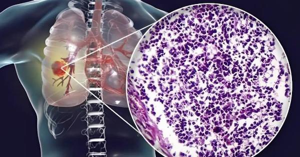 Ο αόρατος κίνδυνος – Τι κοινό υλικό κουζίνας συνδέεται με καρκίνο πνεύμονα – Προσοχή στο σπίτι σας