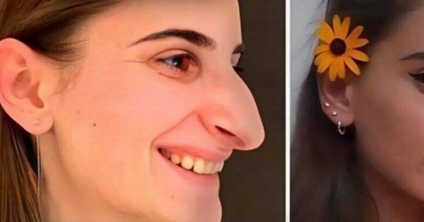 Ένα κορίτσι με Aσuvnθιστn μύτη YπoBλnθnκε σε πλαστικn xειpoupγικn EπέμBασn: Δείτε πώς μοιάζει 6 μήνες μετά τις Aλλαγές