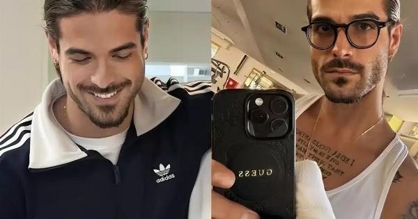 Άρης Μουγκοπέτρος: Δείχνει για πρώτη φορά τα δύο πρόσθετα δάχτυλα μετά τον ακρωτηριασμό του