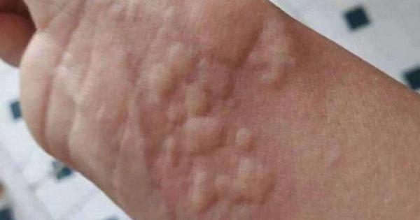 Οι γιατροί προειδοποιούν ότι αν δείτε αυτά τα σημάδια στο δέρμα…