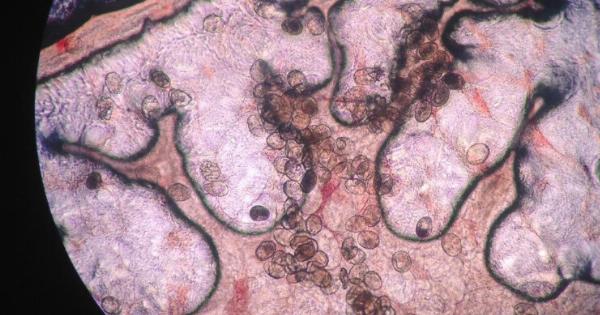 Τρόμος από παρασιτικό σκουλήκι: Προκαλεί καρκίνο και εισβάλλει στο σώμα… χωρίς να το καταλάβεις